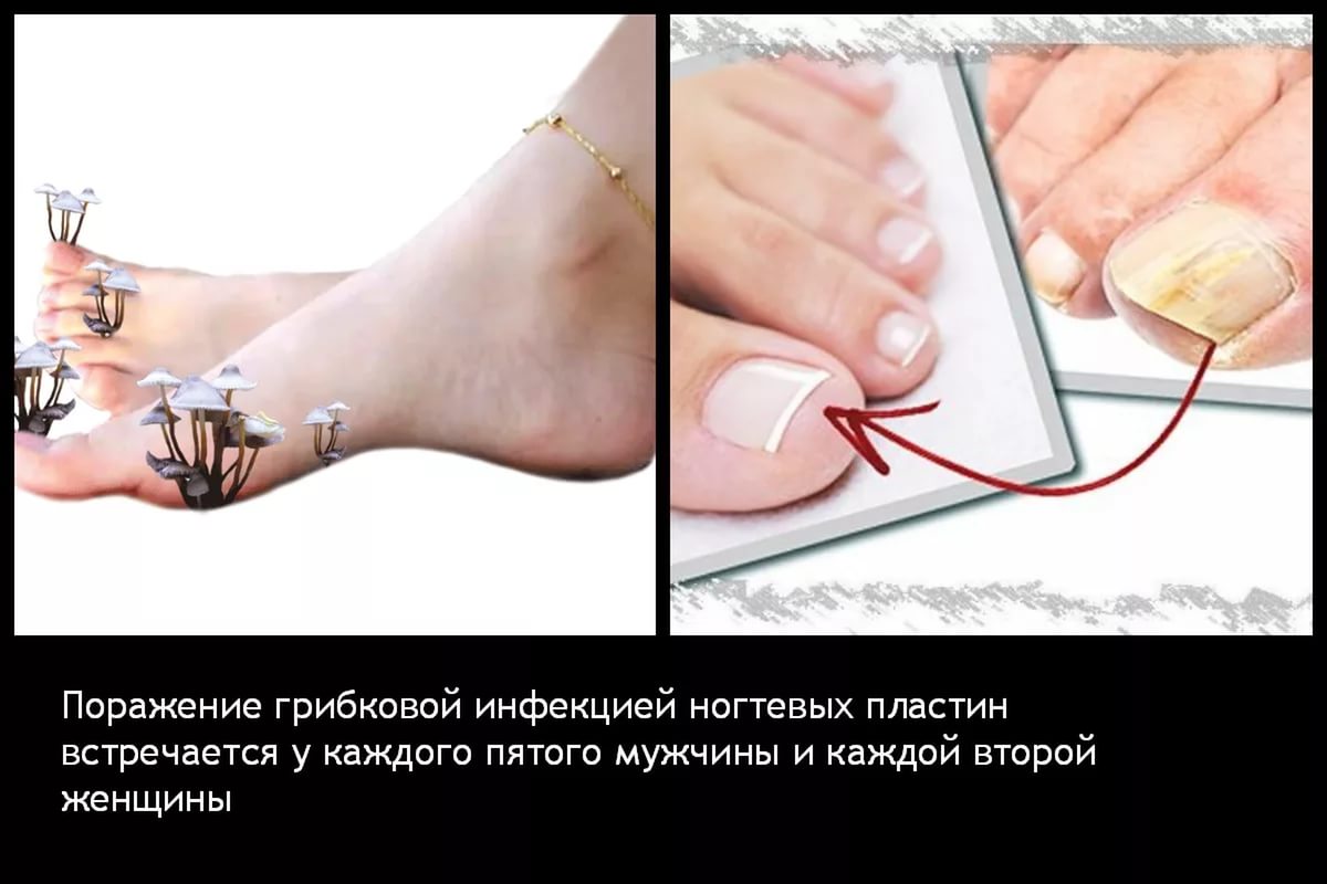 Лечение грибка на ногтях лазером