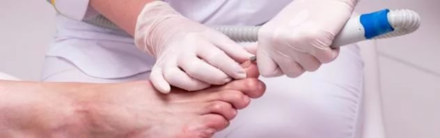 Лечение грибка на ногтях лазером